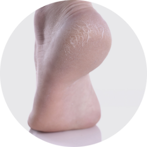 Dry heels and feet