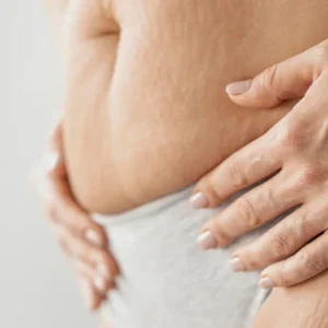 Stretch marks