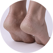 Thickened and callused skin