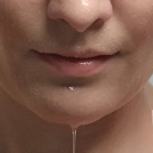 Skin regeneration