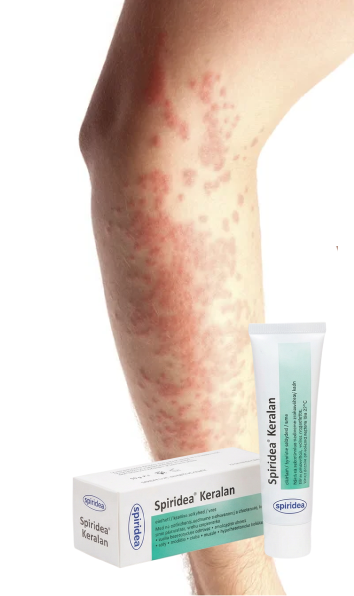 Dry and atopic skin